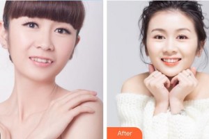 雞西王醫(yī)生整形外科門診部陳添良整形價(jià)格表附隱形托槽矯正案例展示