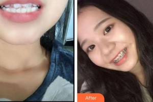 雞西王醫(yī)生整形外科門診部丁優(yōu)整形價(jià)格表附金屬托槽矯正案例展示