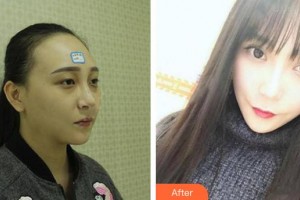 咸陽華爾醫(yī)療美容門診部張秦鵬整形價(jià)格表附埋線雙眼皮案例展示