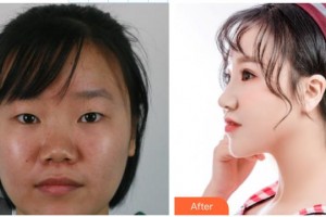 咸陽華爾醫(yī)療美容門診部史娟娟整形價(jià)格表附眼部綜合案例展示