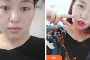 咸陽市第一人民醫(yī)院眼科醫(yī)院許淑云整形價格表附眼部綜合案例展示