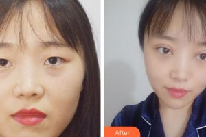 咸陽市第一人民醫(yī)院眼科醫(yī)院杜建英整形價格表附切開雙眼皮案例展示