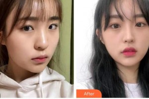 咸陽市第一人民醫(yī)院眼科醫(yī)院張少華整形價格表附眼部綜合案例展示