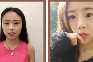 瑞安雅正口腔門診部葉潔整形價(jià)格表附牙齒隱形矯正案例展示