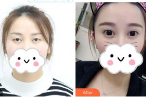 乳山新視力眼科醫(yī)院王景文整形價(jià)格表附眼部綜合案例展示