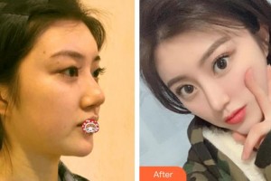 石獅寶島栢麗醫(yī)療美容醫(yī)院黃惠銘整形價(jià)格表附牙齒矯正案例展示