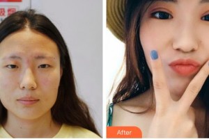 甘肅省康復中心醫(yī)院眼科中心王登廷整形價格表附切開雙眼皮案例展示