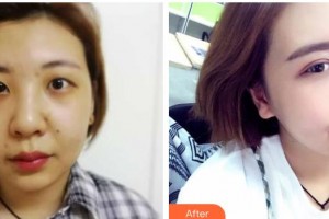 甘肅省人民醫(yī)院燒傷整形科劉俊玲整形價格表附切開雙眼皮案例展示