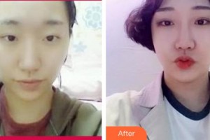 諸暨愛(ài)爾眼科醫(yī)院任遠(yuǎn)望整形價(jià)格表附切開雙眼皮案例展示