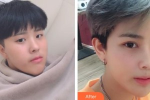 諸暨愛(ài)爾眼科醫(yī)院唐靜曉整形價(jià)格表附外切祛眼袋案例展示