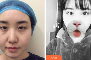 諸暨愛(ài)爾眼科醫(yī)院趙士英整形價(jià)格表附切開雙眼皮案例展示