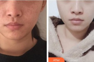 中南大學(xué)湘雅二醫(yī)院燒傷整形外科王先成整形價(jià)格表附激光祛斑案例展示