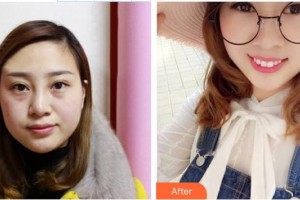 中南大學(xué)湘雅三醫(yī)院燒傷整形外科賀全勇整形價(jià)格表附清潔祛痘案例展示