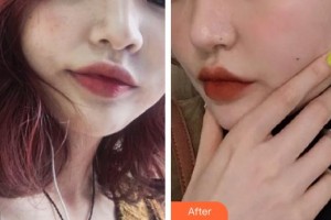 中南大學(xué)湘雅三醫(yī)院燒傷整形外科羅成群整形價(jià)格表附激光祛斑案例展示