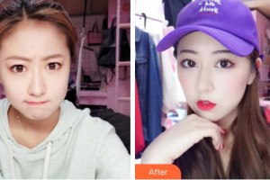 中南大學(xué)湘雅三醫(yī)院燒傷整形外科朱頡整形價(jià)格表附微針?biāo)獍咐故?>
</a>
<h3 class=