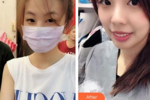 中南大學(xué)湘雅三醫(yī)院燒傷整形外科周建大整形價(jià)格表附皮膚案例展示