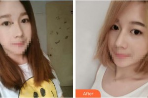 榮成眼科醫(yī)院胡運(yùn)韜整形價(jià)格表附切開雙眼皮案例展示