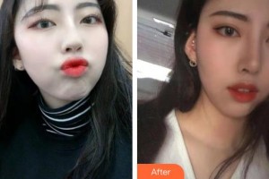 榮成眼科醫(yī)院宋旭東整形價(jià)格表附切開雙眼皮案例展示