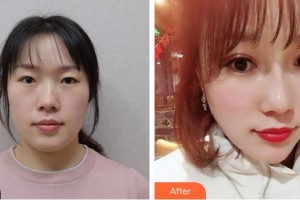 榮成眼科醫(yī)院姚佩君整形價(jià)格表附切開雙眼皮案例展示