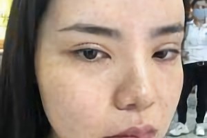 萬家燕王珍祥做下頜角怎么樣截的多嗎？附案例分享+較新價(jià)格表