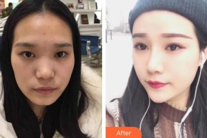 惠陽人民醫(yī)院崇雅路門診部醫(yī)療美容科劉輝良整形價格表附耳軟骨復(fù)合隆鼻案例展示