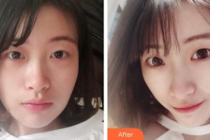 惠陽長安醫(yī)院整形美容中心高慧寧整形價格表附假體隆鼻案例展示