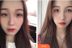 龍口光明眼科醫(yī)院范慧君整形價格表附切開雙眼皮案例展示