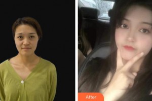 龍口光明眼科醫(yī)院梁學(xué)民整形價格表附眼部綜合案例展示