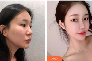 龍口光明眼科醫(yī)院徐鑫彥整形價格表附眼部綜合案例展示