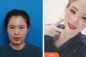 龍口光明眼科醫(yī)院孫先勇整形價格表附眼部修復(fù)案例展示