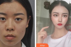 龍口光明眼科醫(yī)院李健整形價格表附眼部綜合案例展示