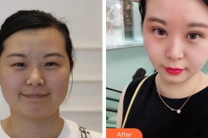 龍口光明眼科醫(yī)院金震整形價格表附定點(diǎn)雙眼皮案例展示