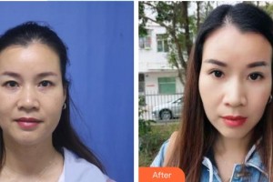 龍口光明眼科醫(yī)院于鵬林整形價格表附切開雙眼皮案例展示