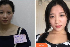 宜興韓美人醫(yī)療美容診所張鐘烈整形價(jià)格表附清潔祛痘案例展示