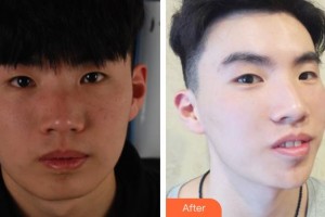 宜興洵美會(huì)醫(yī)療美容門診部汪浩平整形價(jià)格表附E光嫩膚案例展示