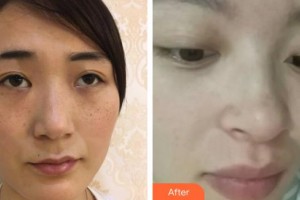 宜興市中醫(yī)院整形美容科李國春整形價(jià)格表附清潔祛痘案例展示