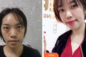 濟源林華醫(yī)療美容門診部李方整形價格表附眼部綜合案例展示