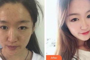 濟源林華醫(yī)療美容門診部王濤澎整形價格表附激光去眼袋案例展示