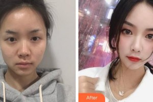 濟源尖峰眼科醫(yī)院張磊整形價格表附開內眼角案例展示