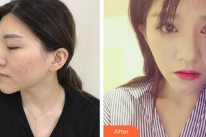 濟源尖峰眼科醫(yī)院賈劉才整形價格表附切開雙眼皮案例展示