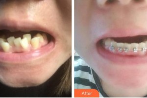 濟源向日葵口腔門診部李斌整形價格表附金屬托槽矯正案例展示