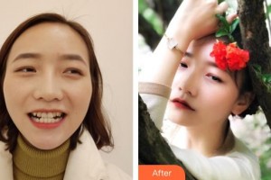 濟源霍氏口腔醫(yī)院段宗華整形價格表附牙齒隱形矯正案例展示