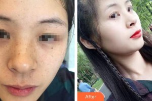 大理金格醫(yī)療美容醫(yī)院姚明華整形價格表附激光祛斑案例展示