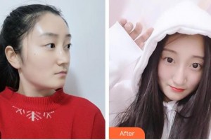 唐河?xùn)|方眼科醫(yī)院袁育新整形價(jià)格表附眼部綜合案例展示