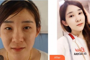 唐河?xùn)|方眼科醫(yī)院賈志軍整形價(jià)格表附眼部綜合案例展示