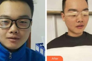 唐河?xùn)|方眼科醫(yī)院袁獻(xiàn)華整形價(jià)格表附眼部綜合案例展示