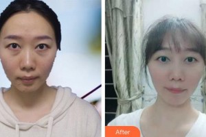 唐河?xùn)|方眼科醫(yī)院張清勇整形價(jià)格表附激光去眼袋案例展示