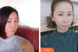 唐河?xùn)|方眼科醫(yī)院白珣整形價(jià)格表附切開雙眼皮案例展示