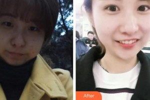 郯城新益民眼科醫(yī)院田作龍整形價(jià)格表附眼部綜合案例展示