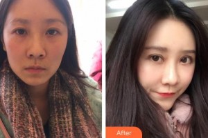 郯城新益民眼科醫(yī)院楊玉英整形價(jià)格表附外切祛眼袋案例展示